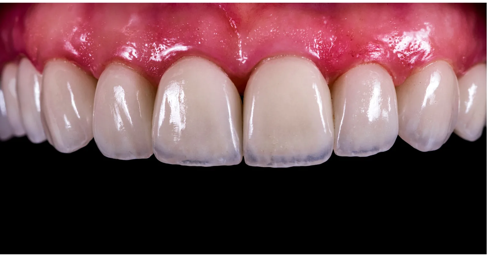 After smile restoration