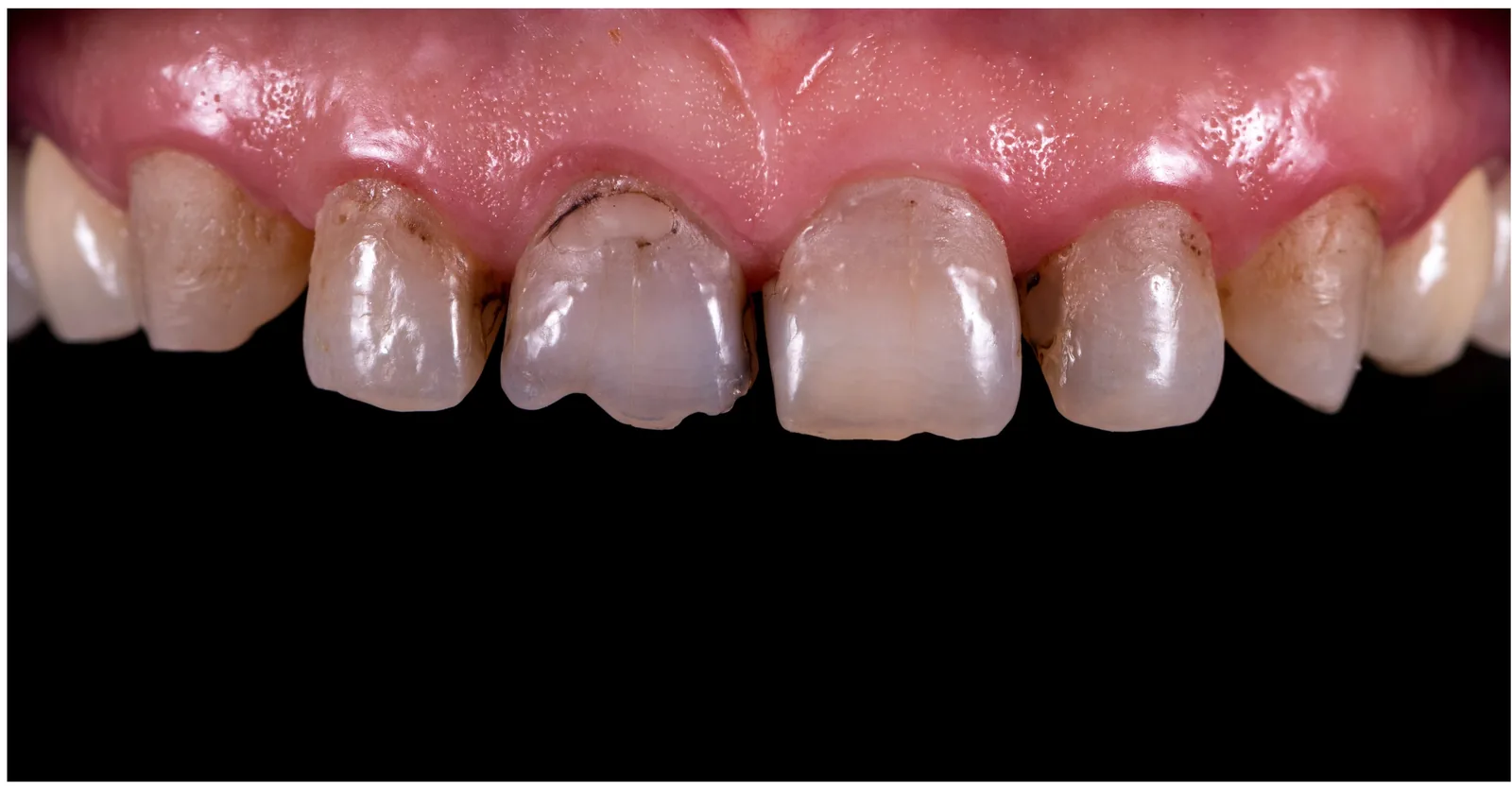 Before smile restoration