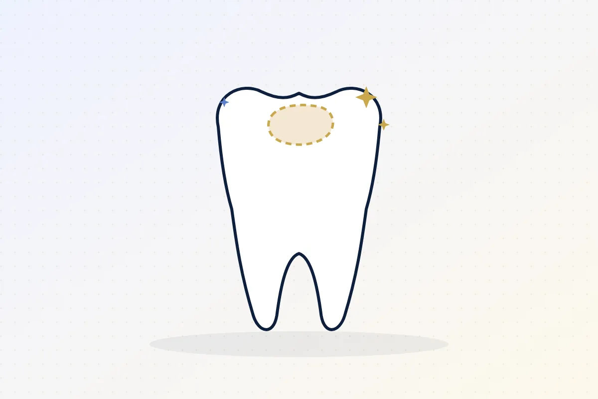Illustration of a molar with a tooth-colored composite filling