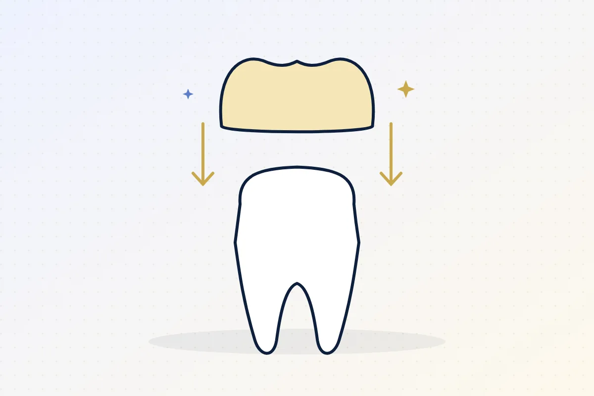 Illustration of a dental crown being placed over a prepared tooth