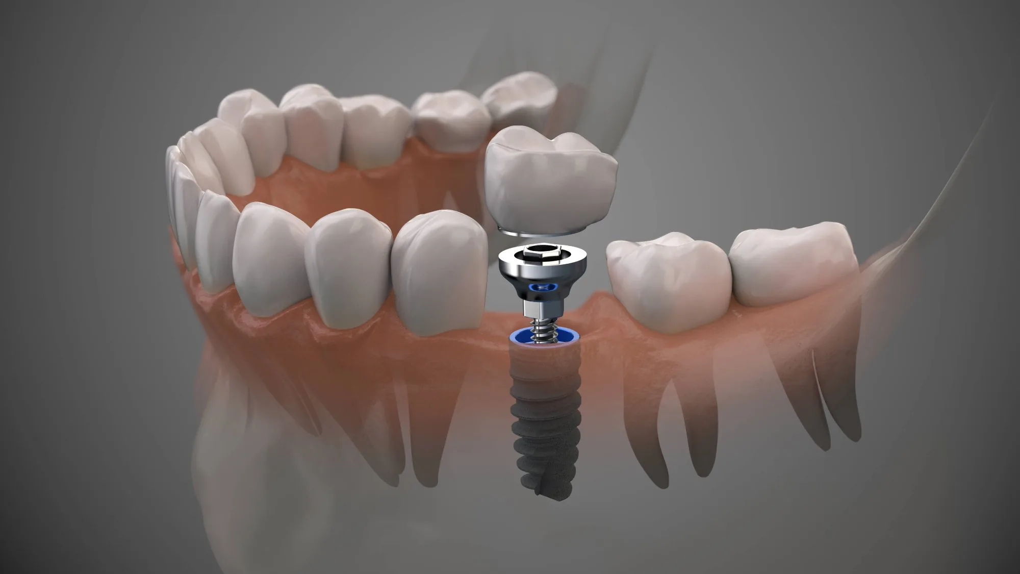 Dental implant procedure at Astra Dental in Franklin Park IL