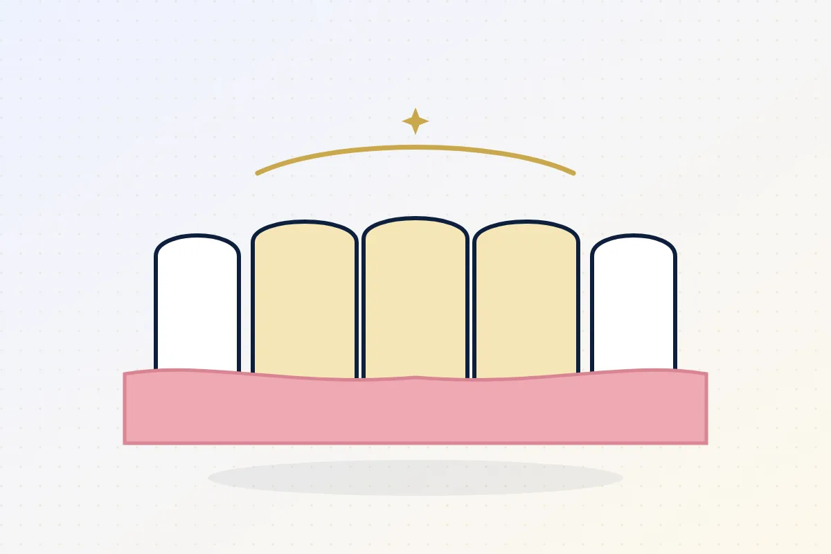 Illustration of a three-unit fixed ceramic dental bridge replacing a missing tooth