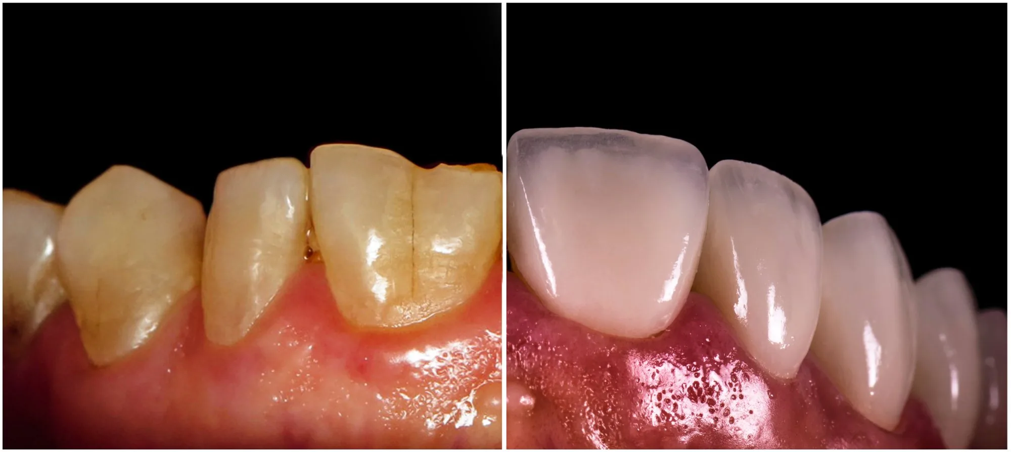 Porcelain veneers before and after at Astra Dental Franklin Park IL