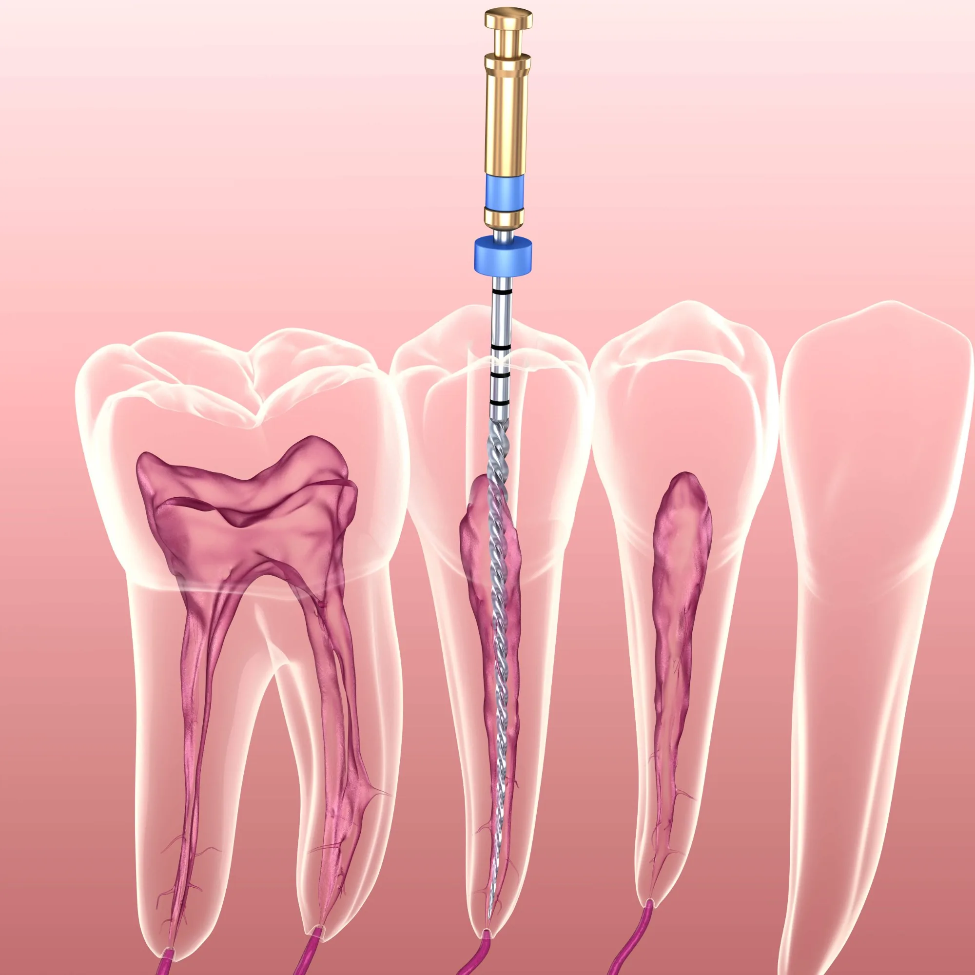 Root canal treatment at Astra Dental in Franklin Park IL