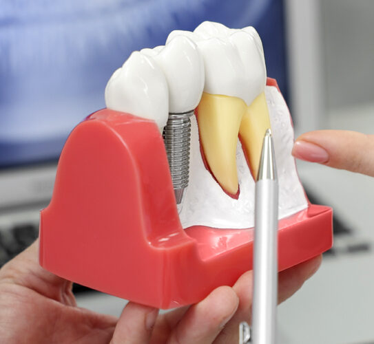 Dental Implants & Restorations