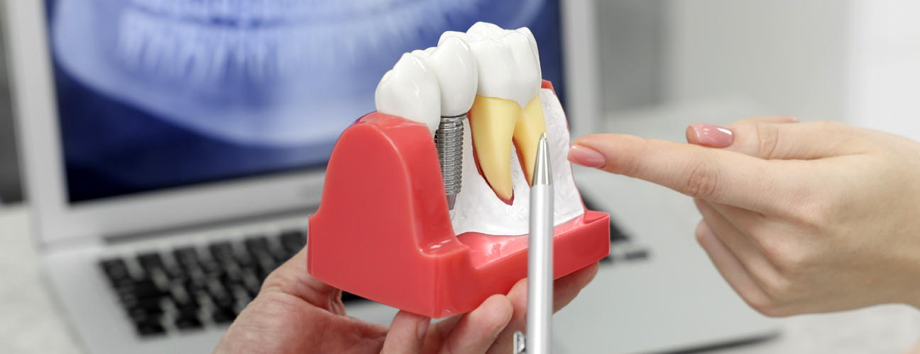 Dental Implants & Restorations