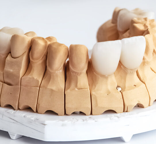 Dental Veneers