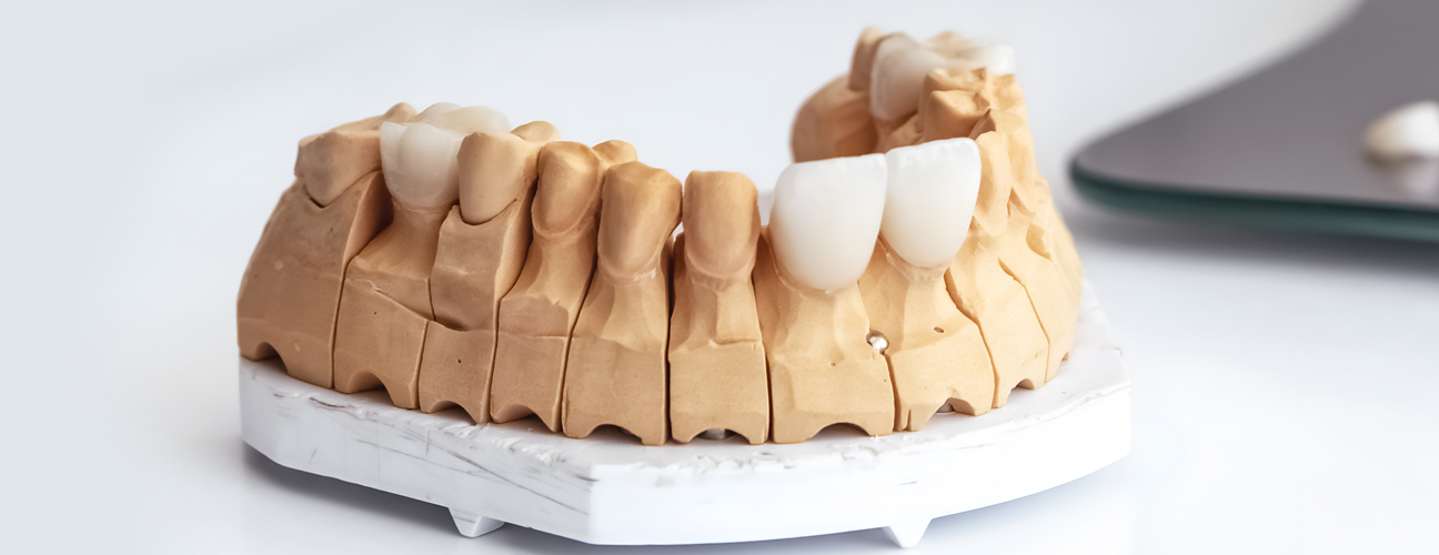 Dental Veneers