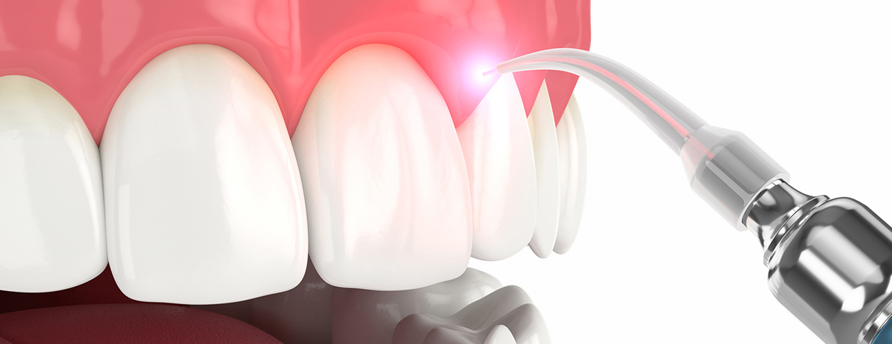 Laser Dentistry